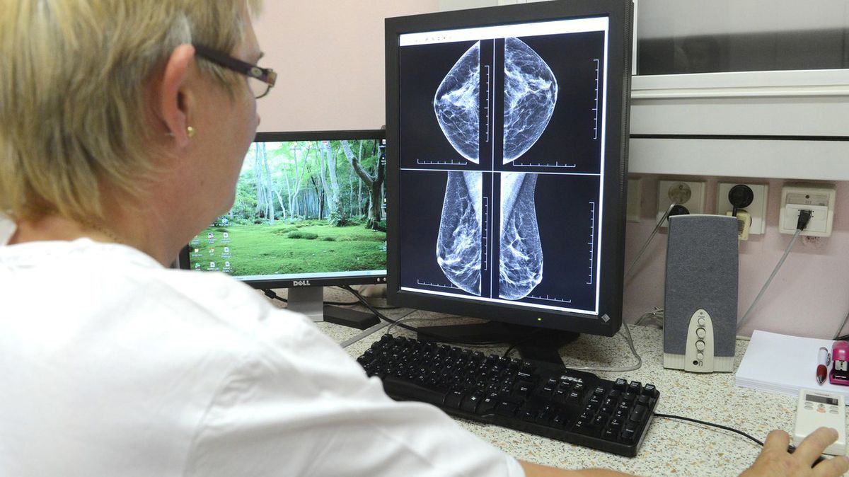Žena varuje před mamografem, ministerstvo se kvůli poplašné zprávě obrátí na policii